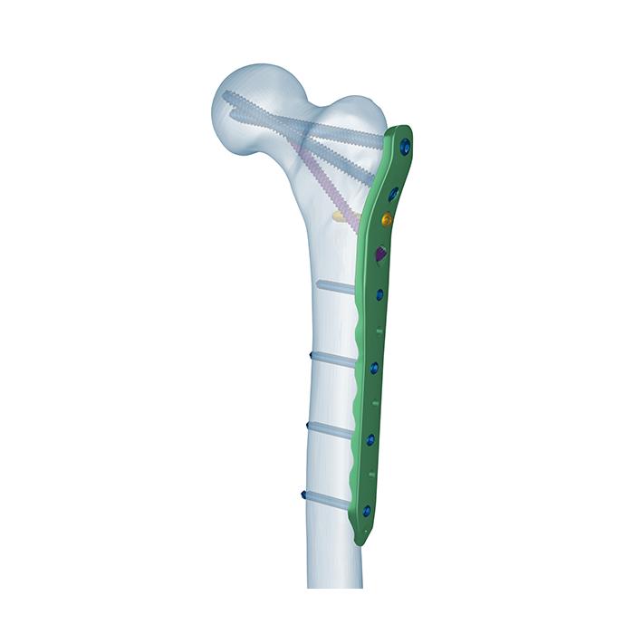 لوح تثبيت عظم الفخذ القريب المقفل (Proximal Femoral Locking Plate)